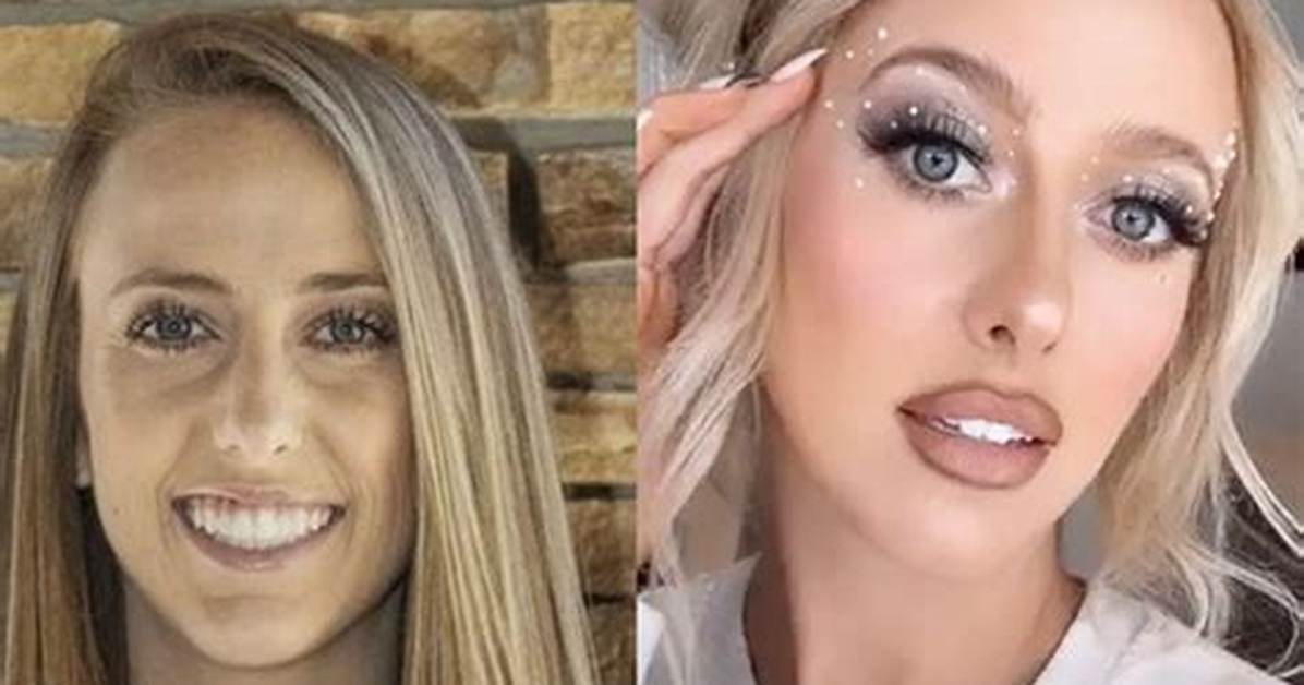 Brittany Mahomes’ Plastic Surgery: Did She Get Lip Fillers and Breast Implants?