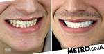 Love Island Luca Bish Teeth Before Coming to the Show: Has He Whitened Them