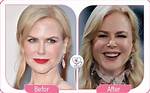 Nicole Kidman Facelift: a Comprehensive Look at Her Transformation