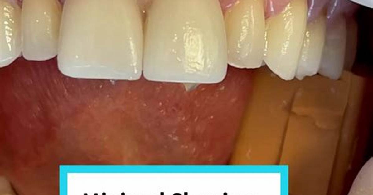 Teeth Shaving for Veneers: Why Tiktok's Shark Teeth Procedure Is Wrong and Dangerous, Accordin