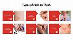 Understanding and Managing Inner Thigh Rash: a Comprehensive Guide