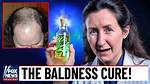 Understanding Barbara O'neill's Hair Loss Journey
