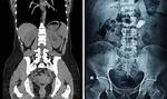 Understanding the Aftermath: Kidney Removal Scarring