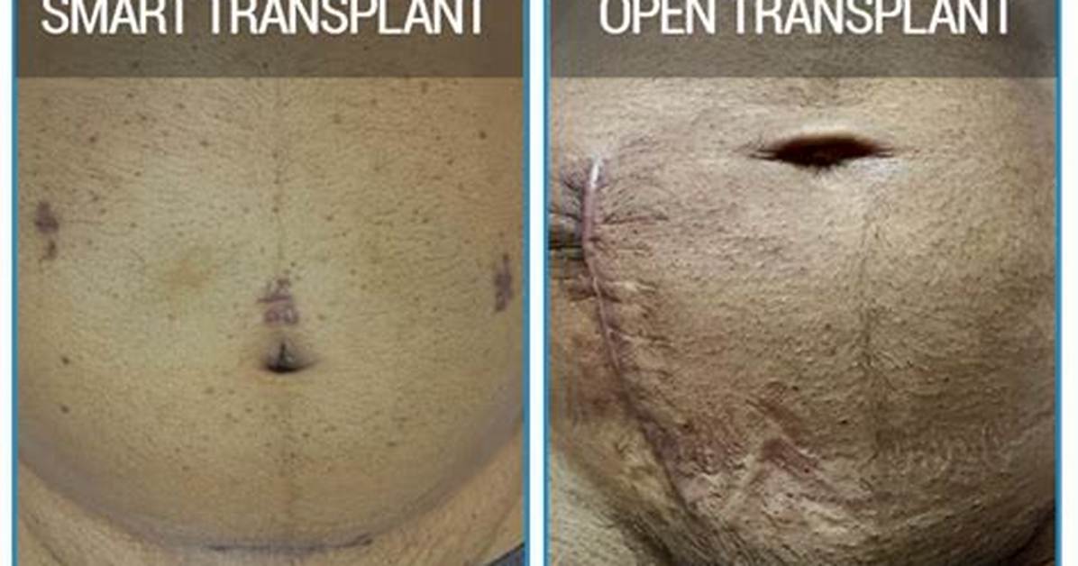 Unveiling the Secrets of Kidney Transplant Scars