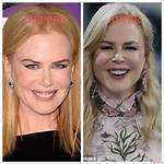 Unveiling the Truth: Nicole Kidman's Plastic Surgery Journey